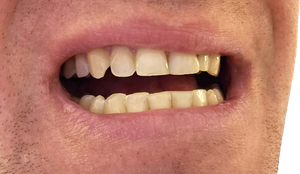 a patient with dental staining
